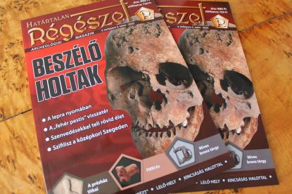 A TBC, a szifilisz és a lepra döbbenetes hatása a csontokra A TBC, a szifilisz és a lepra döbbenetes hatása a csontokra